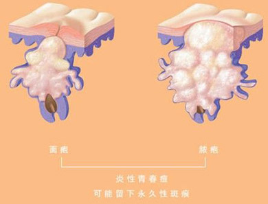 佐康痘坑修复